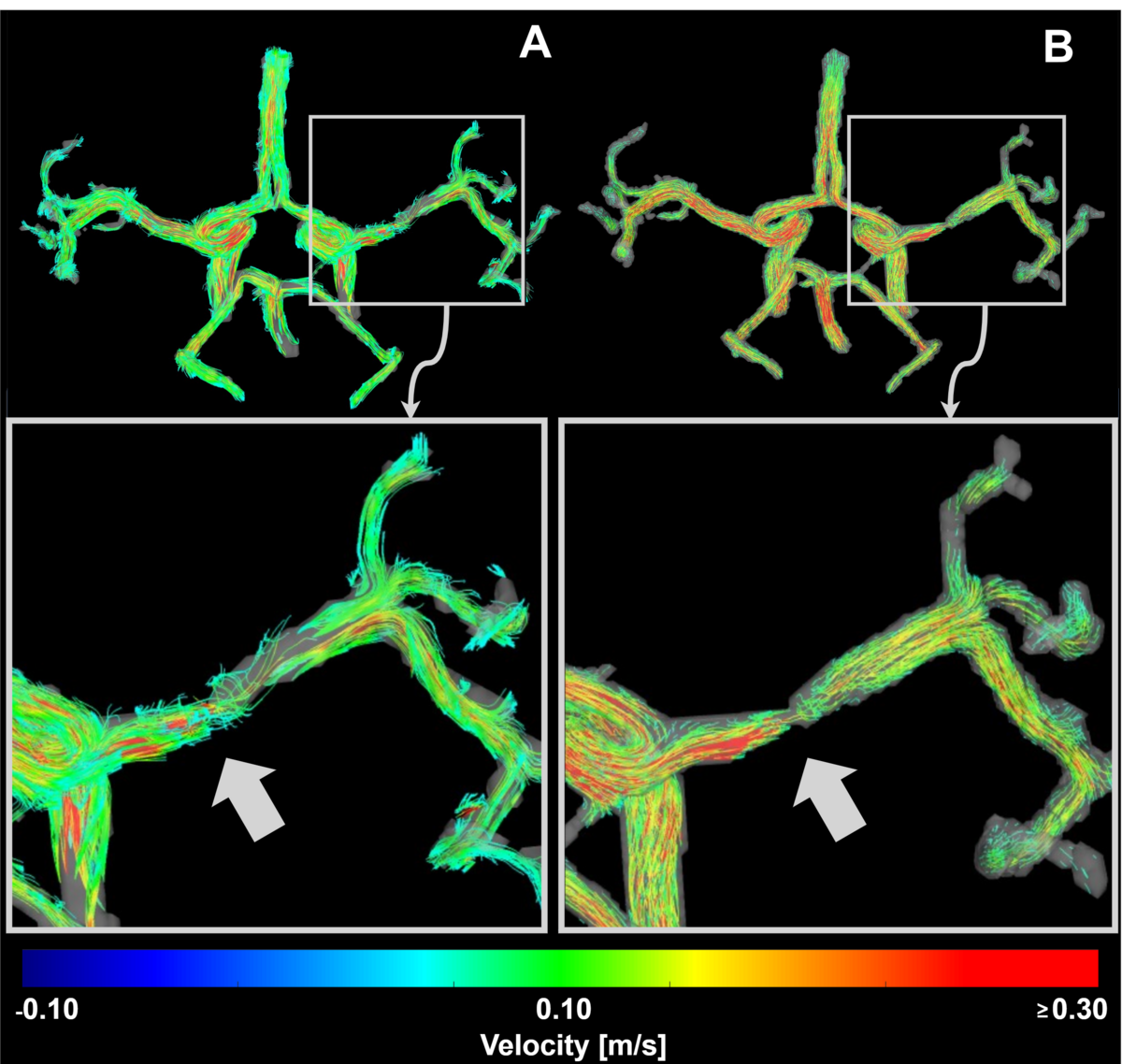 Non-invasive Evaluation of Intracranial Atherosclerotic Disease Using Hemodynamic Biomarkers